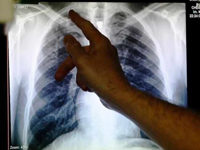 Người phụ nữ 36 tuổi mắc ung thư phổi nhưng bị bác sĩ chẩn đoán nhầm thành tình trạng trào ngược axit dạ dày - Ảnh 1.