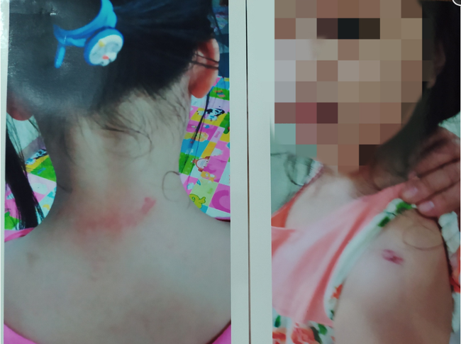 Không khởi tố vụ 2 bé gái nghi bị cha dượng bạo hành ở Hà Nội - Ảnh 1.