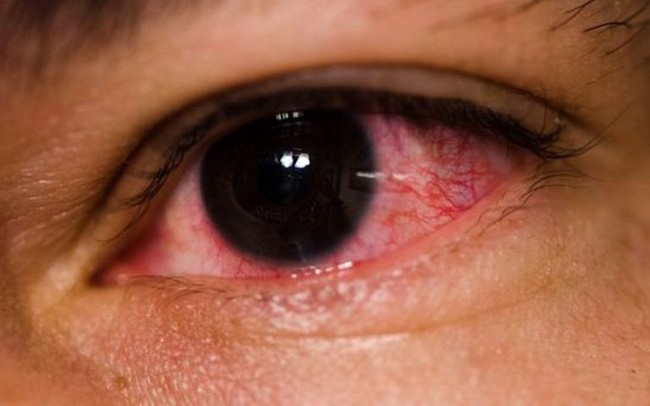 Chuyên gia chỉ rõ nguyên nhân khiến nhiều người bị đau mắt đỏ trong thời điểm hiện tại - Ảnh 1.