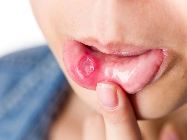 Dấu hiệu trong miệng tưởng chừng bệnh thông thường nhưng lại có thể là dấu hiệu ung thư - Ảnh 2.