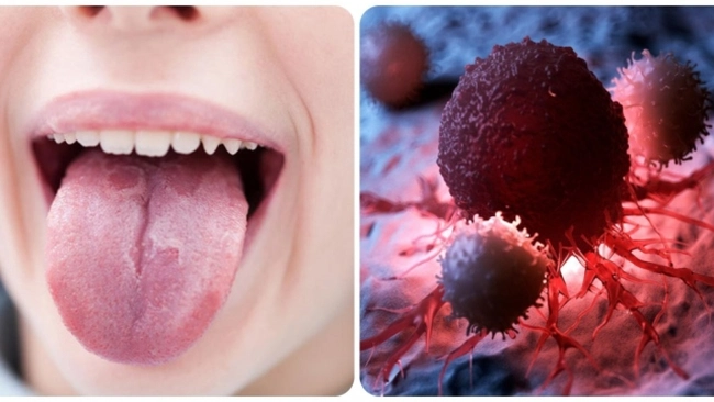 Dấu hiệu trong miệng tưởng chừng bệnh thông thường nhưng lại có thể là dấu hiệu ung thư - Ảnh 1.