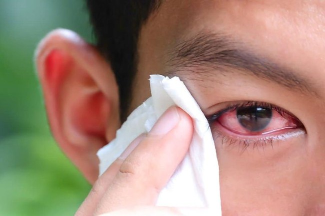 Bác sĩ chuyên khoa chia sẻ lý do khiến dịch đau mắt đỏ phức tạp hơn mọi năm và 4 lưu ý quan trọng khi điều trị bệnh - Ảnh 1.