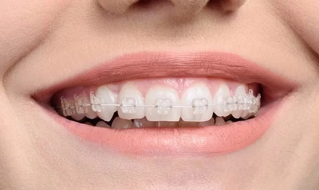 Niềng răng để răng đều hạt bắp, khuôn mặt cân đối bất ngờ: Có 5 kiểu cho bạn thỏa sức lựa chọn! - Ảnh 3.