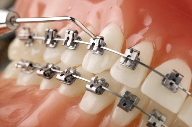 Niềng răng để răng đều hạt bắp, khuôn mặt cân đối bất ngờ: Có 5 kiểu cho bạn thỏa sức lựa chọn! - Ảnh 4.