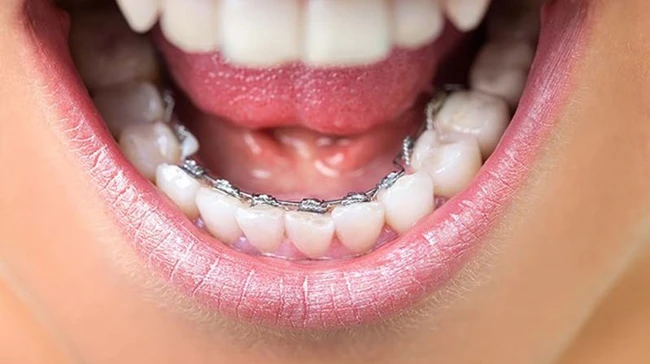 Niềng răng để răng đều hạt bắp, khuôn mặt cân đối bất ngờ: Có 5 kiểu cho bạn thỏa sức lựa chọn! - Ảnh 5.