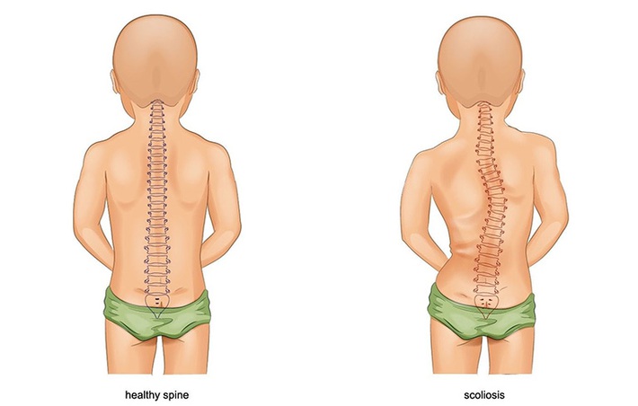 Cong vẹo cột sống ở trẻ em: Nguyên nhân, triệu chứng và cách phòng ngừa - Ảnh 1.