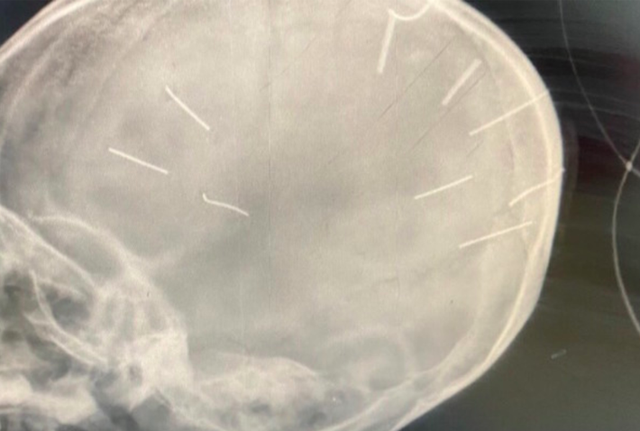 Bé gái 3 tuổi bị 9 chiếc đinh găm vào đầu: Từng hôn mê vì ngộ độc thuốc trừ sâu, 3 tháng nhập viện 3 lần - Ảnh 1.