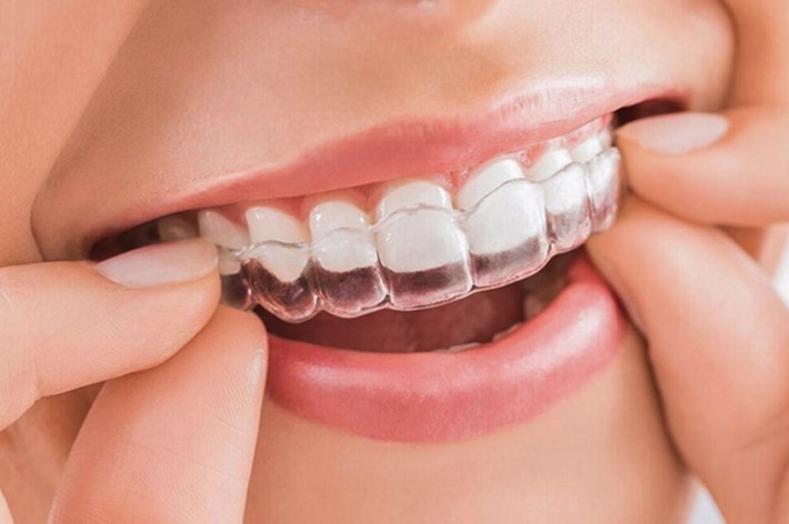 Niềng răng cũng có nhiều loại nhưng bạn chọn loại nào để nhanh chóng có hàm răng đều như hạt bắp? - Ảnh 7.